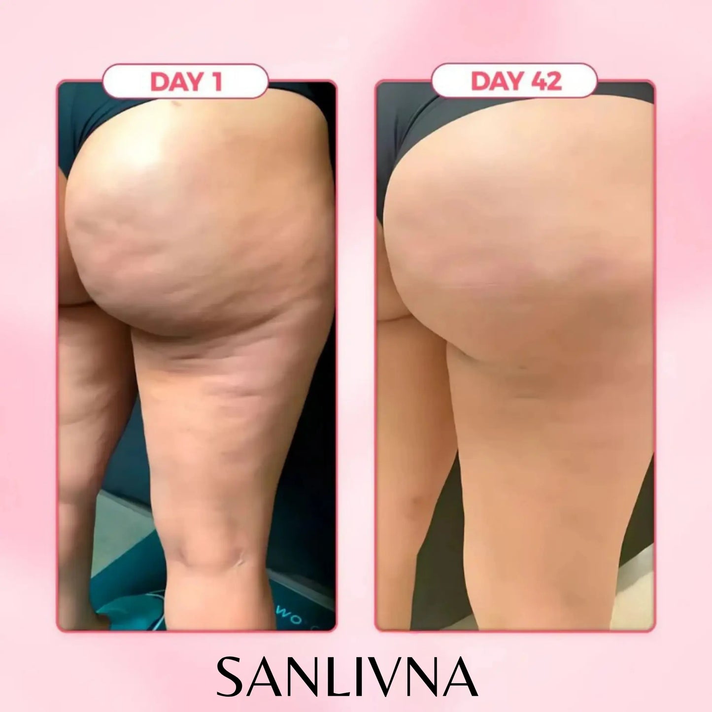 Sanlivna™ | Anti-Cellulite Set | über 15.000+ Verkauft
