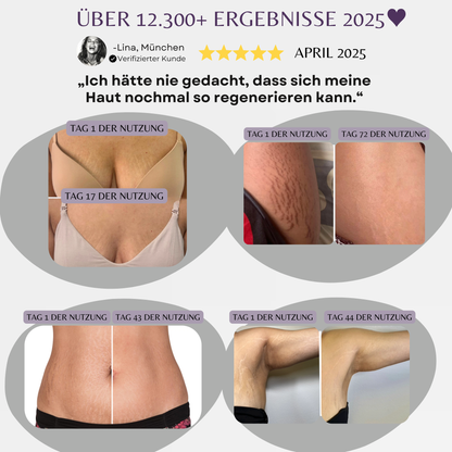 Öl gegen Dehnungsstreifen | 100ml Premium Hautpflege